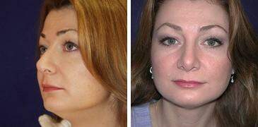 Patient 7256, Neck Liposuction Before and After Photos Neck Liposuction Before and After Photos in Lexington, KY, Patient 7256