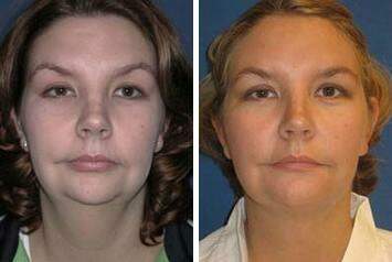 Patient 7263, Neck Liposuction Before and After Photos Neck Liposuction Before and After Photos in Lexington, KY, Patient 7263