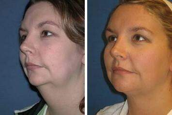Patient 7263, Neck Liposuction Before and After Photos Neck Liposuction Before and After Photos in Lexington, KY, Patient 7263