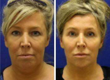 Patient 7273, Neck Liposuction Before and After Photos Neck Liposuction Before and After Photos in Lexington, KY, Patient 7273