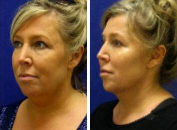 Patient 7273, Neck Liposuction Before and After Photos Neck Liposuction Before and After Photos in Lexington, KY, Patient 7273