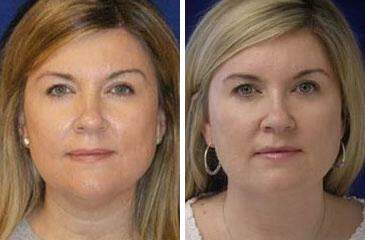 Patient 7228, Neck Liposuction Before and After Photos Neck Liposuction Before and After Photos in Lexington, KY, Patient 7228
