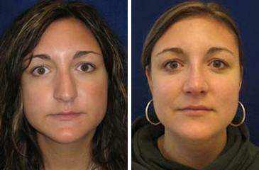 Patient 7090, Nose Reshaping (Rhinoplasty) Before and After Photos Nose Reshaping (Rhinoplasty) Before and After Photos in Lexington, KY, Patient 7090