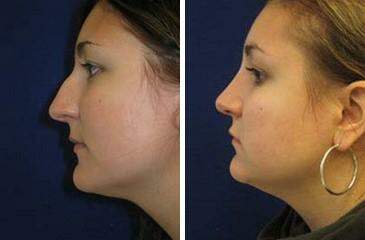 Patient 7090, Nose Reshaping (Rhinoplasty) Before and After Photos Nose Reshaping (Rhinoplasty) Before and After Photos in Lexington, KY, Patient 7090