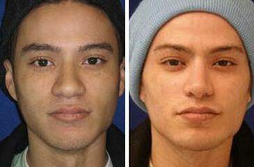 Patient 7110, Nose Reshaping (Rhinoplasty) Before and After Photos Nose Reshaping (Rhinoplasty) Before and After Photos in Lexington, KY, Patient 7110