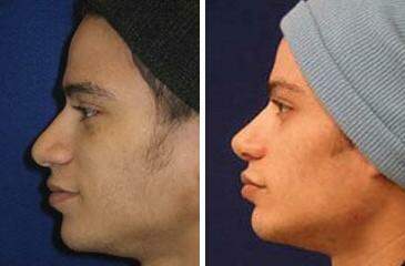 Patient 7110, Nose Reshaping (Rhinoplasty) Before and After Photos Nose Reshaping (Rhinoplasty) Before and After Photos in Lexington, KY, Patient 7110
