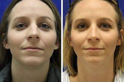 Patient 7030, Nose Reshaping (Rhinoplasty) Before and After Photos Nose Reshaping (Rhinoplasty) Before and After Photos in Lexington, KY, Patient 7030