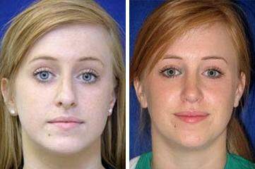 Patient 7120, Nose Enhancement Before and After Photos Nose Enhancement Before and After Photos in Lexington, KY, Patient 7120