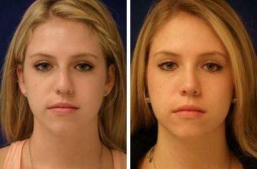 Patient 7130, Nose Reshaping (Rhinoplasty) Before and After Photos Nose Reshaping (Rhinoplasty) Before and After Photos in Lexington, KY, Patient 7130