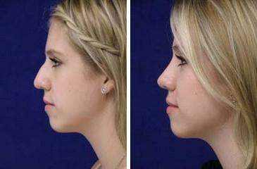 Patient 7130, Nose Reshaping (Rhinoplasty) Before and After Photos Nose Reshaping (Rhinoplasty) Before and After Photos in Lexington, KY, Patient 7130