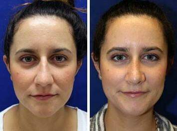 Patient 7150, Nose Reshaping (Rhinoplasty) Before and After Photos Nose Reshaping (Rhinoplasty) Before and After Photos in Lexington, KY, Patient 7150
