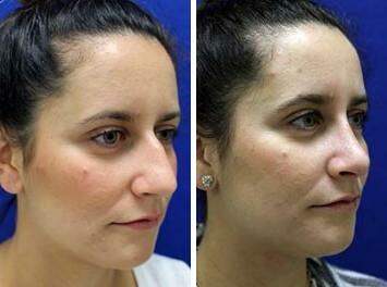Patient 7150, Nose Reshaping (Rhinoplasty) Before and After Photos Nose Reshaping (Rhinoplasty) Before and After Photos in Lexington, KY, Patient 7150