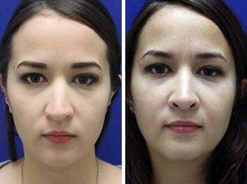 Patient 7160, Nose Enhancement Before and After Photos Nose Enhancement Before and After Photos in Lexington, KY, Patient 7160