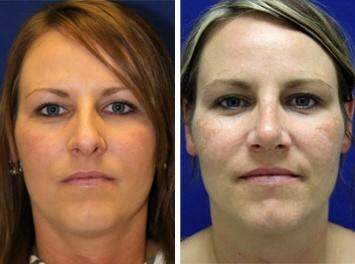 Patient 7170, Nose Enhancement Before and After Photos Nose Enhancement Before and After Photos in Lexington, KY, Patient 7170