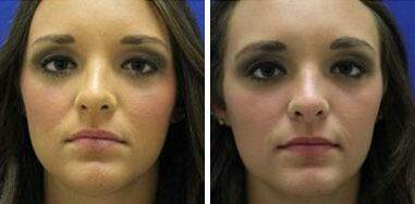 Patient 7180, Nose Enhancement Before and After Photos Nose Enhancement Before and After Photos in Lexington, KY, Patient 7180