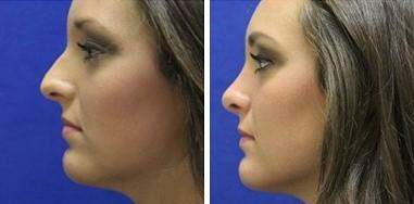 Patient 7180, Nose Enhancement Before and After Photos Nose Enhancement Before and After Photos in Lexington, KY, Patient 7180
