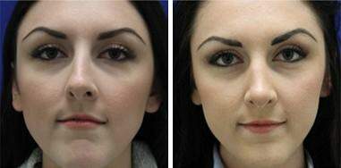 Patient 7190, Nose Enhancement Before and After Photos Nose Enhancement Before and After Photos in Lexington, KY, Patient 7190
