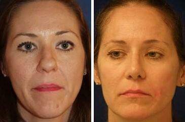 Patient 7040, Nose Reshaping (Rhinoplasty) Before and After Photos Nose Reshaping (Rhinoplasty) Before and After Photos in Lexington, KY, Patient 7040