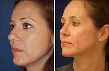 Patient 7040, Nose Reshaping (Rhinoplasty) Before and After Photos Nose Reshaping (Rhinoplasty) Before and After Photos in Lexington, KY, Patient 7040
