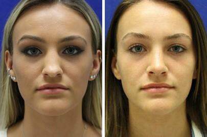 Patient 7020, Nose Enhancement Before and After Photos Nose Enhancement Before and After Photos in Lexington, KY, Patient 7020