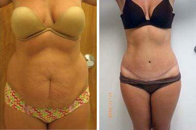 Patient 7390, Tummy Tuck Before and After Photos Tummy Tuck Before and After Photos in Lexington, KY, Patient 7390