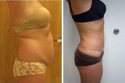 Patient 7390, Tummy Tuck Before and After Photos Tummy Tuck Before and After Photos in Lexington, KY, Patient 7390