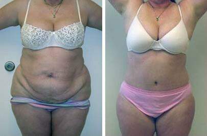 Patient 7400, Tummy Tuck Before and After Photos Tummy Tuck Before and After Photos in Lexington, KY, Patient 7400