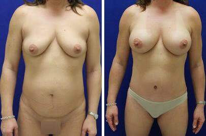 Patient 7360, Tummy Tuck Before and After Photos Tummy Tuck Before and After Photos in Lexington, KY, Patient 7360