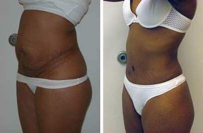 Patient 7450, Tummy Tuck Before and After Photos Tummy Tuck Before and After Photos in Lexington, KY, Patient 7450