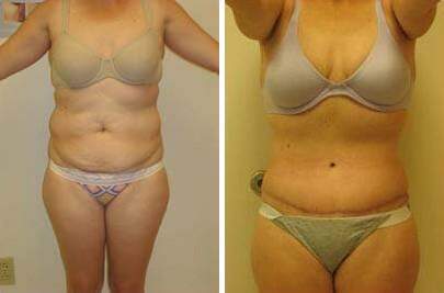 Patient 7460, Tummy Tuck Before and After Photos Tummy Tuck Before and After Photos in Lexington, KY, Patient 7460