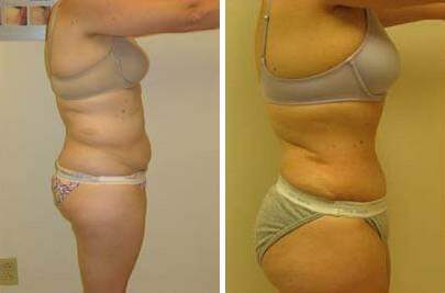 Patient 7460, Tummy Tuck Before and After Photos Tummy Tuck Before and After Photos in Lexington, KY, Patient 7460