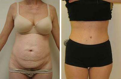 Patient 7470, Tummy Tuck Before and After Photos Tummy Tuck Before and After Photos in Lexington, KY, Patient 7470
