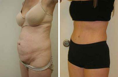 Patient 7470, Tummy Tuck Before and After Photos Tummy Tuck Before and After Photos in Lexington, KY, Patient 7470