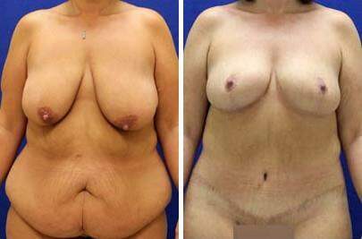 Patient 7504, Tummy Tuck Before and After Photos Tummy Tuck Before and After Photos in Lexington, KY, Patient 7504