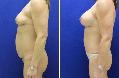 Patient 7360, Tummy Tuck Before and After Photos Tummy Tuck Before and After Photos in Lexington, KY, Patient 7360