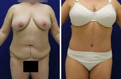 Patient 7370, Tummy Tuck Before and After Photos Tummy Tuck Before and After Photos in Lexington, KY, Patient 7370