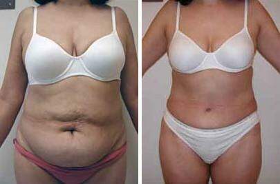 Patient 7380, Tummy Tuck Before and After Photos Tummy Tuck Before and After Photos in Lexington, KY, Patient 7380
