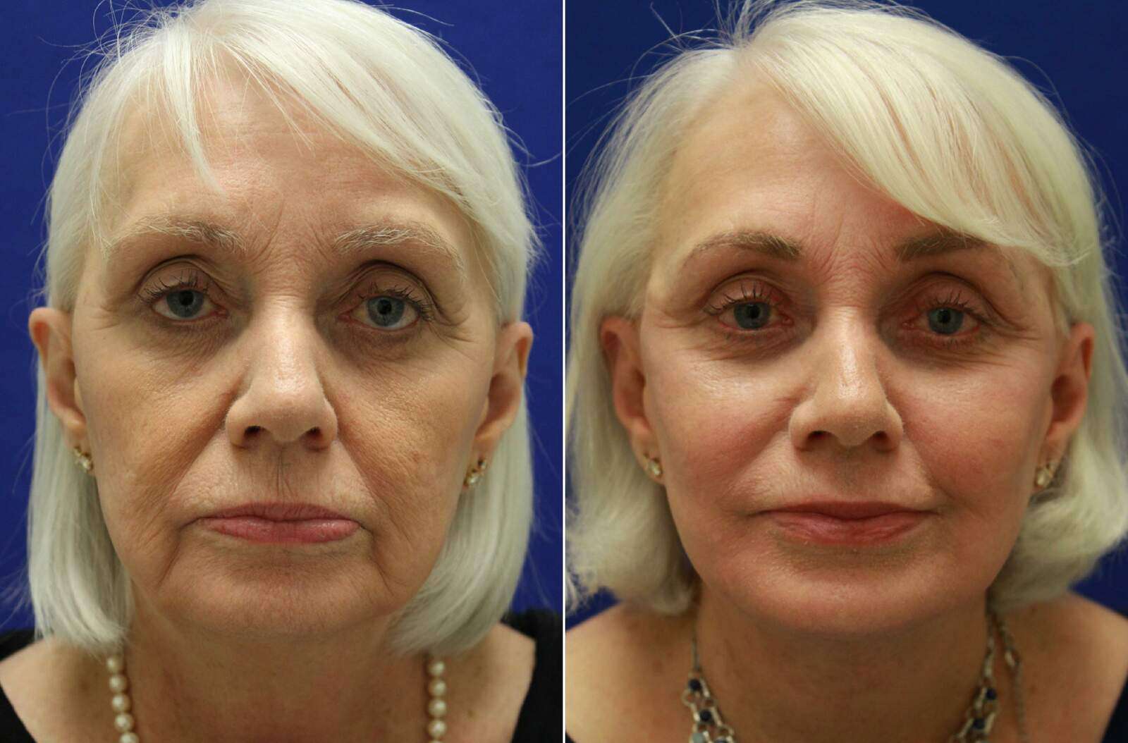  Before and After Photos in , , Facelift