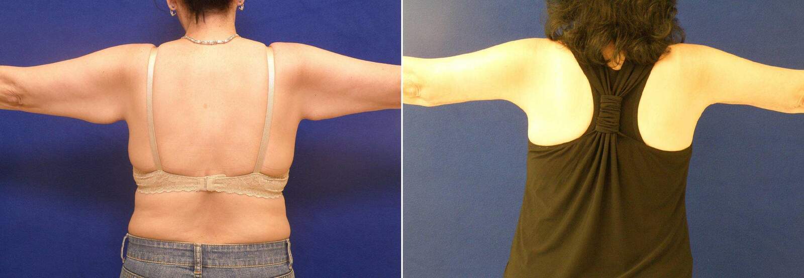 Before and After Photos in , , Arm Lift in Lexington, KY