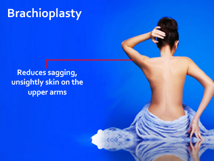 Dr. Schantz performs brachioplasty as an outpatient. This procedure is usually done under a general anesthesia and takes approximately 3 hours to complete.