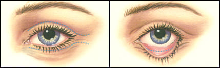 In upper eyelid surgery, Dr. Waldman first marks the individual lines and crease of the lids in order to keep the incisions as invisible as possible along the natural folds.