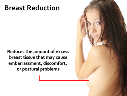 This procedure is commonly covered by insurance though insurance criteria are becoming more and more restrictive. Breast Reduction in Lexington, KY
