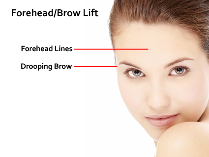 The surgery begins with the placement of the incision. In many cases the incision is made slightly behind the hairline. Dr. Waldman | Lexington, KY