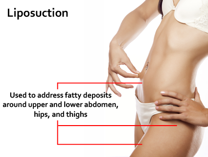 Compression is advised for about six weeks as it helps reduce swelling and helps you achieve the final results more quickly. Liposuction in Lexington, KY