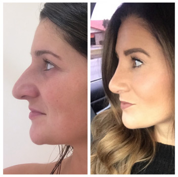 Revision Rhinoplasty Photo Gallery - DrDavid WKim