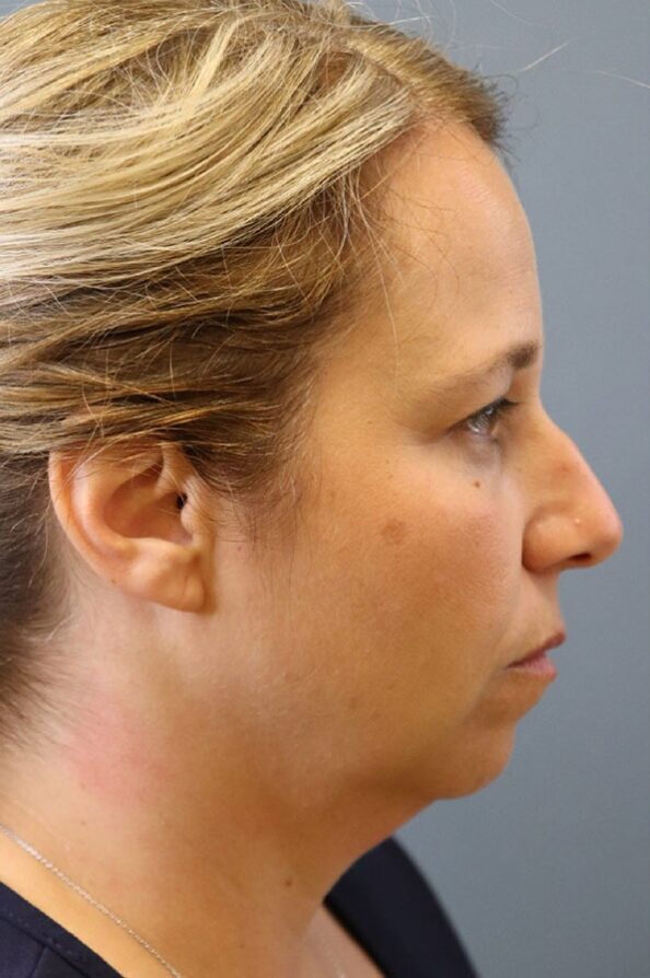 Neck Liposuction in Lexington, KY
